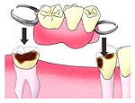 水野歯科クリニック　入れ歯　マグネット式　従来の入れ歯の場合